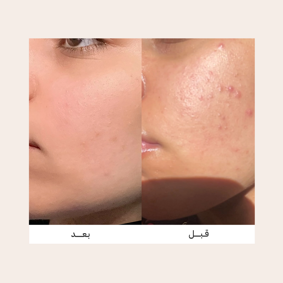 VIVIAN 10% Azelaic Acid Cream Multi-Care Formula